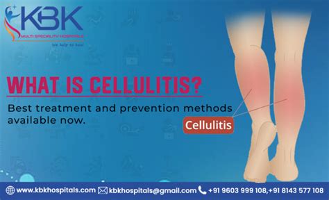 bir (rdo 75) photos|Best Practices in the Diagnosis and Treatment of Cellulitis and .